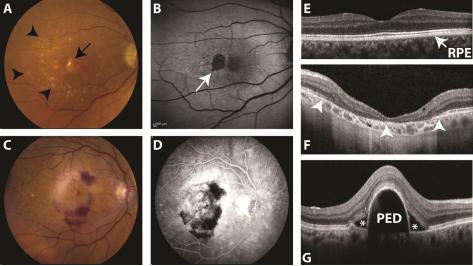 AMD Multimodal Imaging